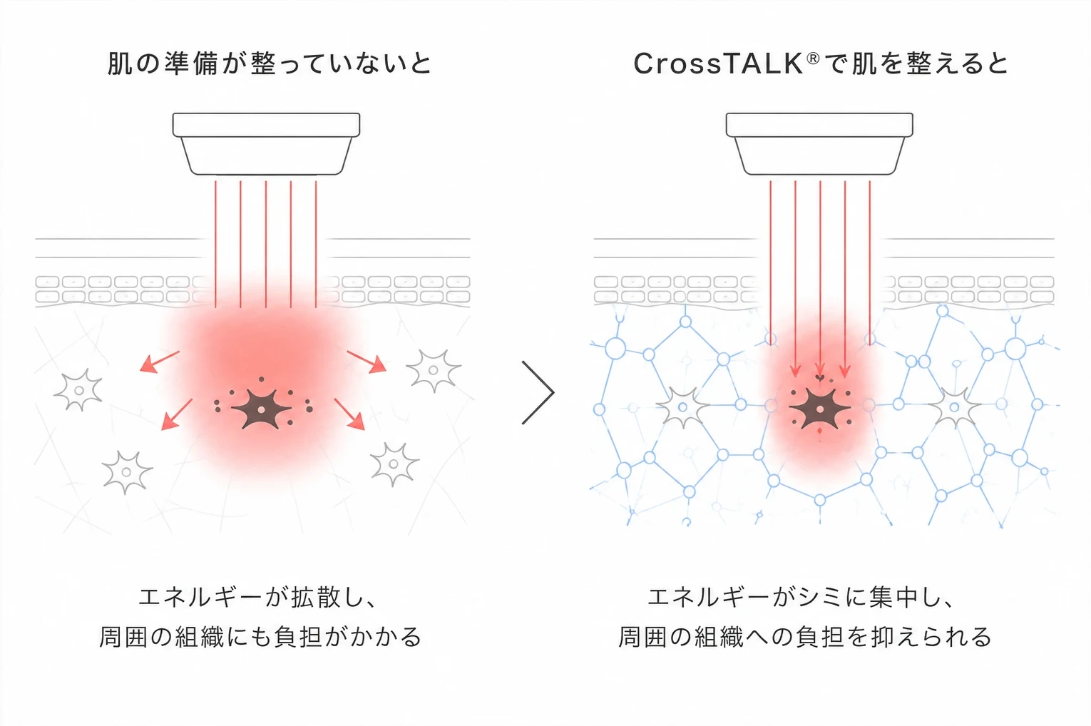 肌の準備の有無によるレーザーエネルギーの広がり方の違いを示す比較図