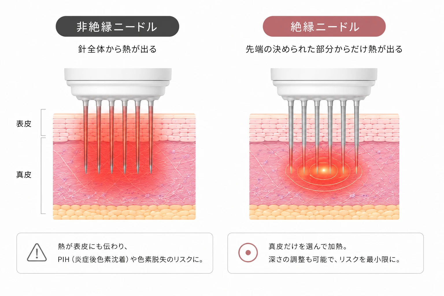 非絶縁ニードル(針全体から熱が出る)と絶縁ニードル(先端の決められた部分からだけ熱が出る)の違いを示す比較図