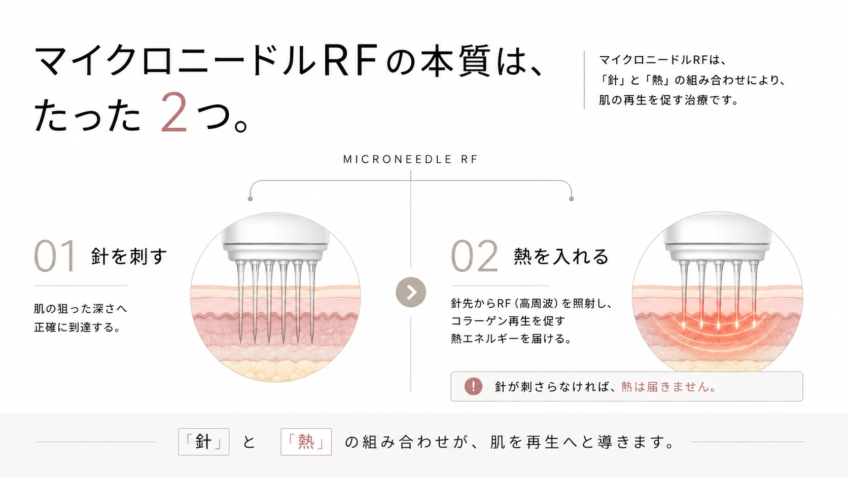 マイクロニードルRFの本質は「針を刺す」と「熱を入れる」の2つであることを示す図解