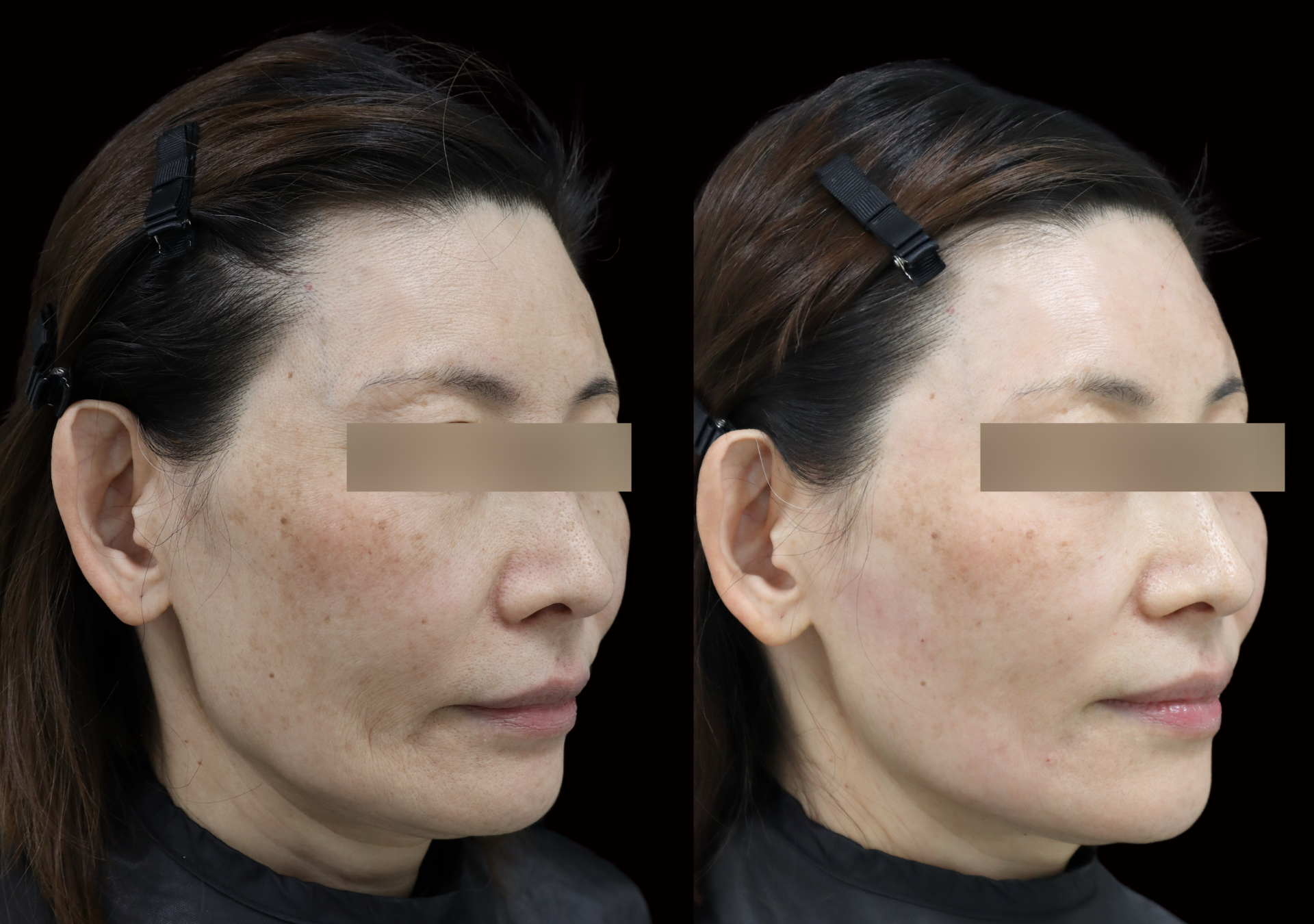 ヒアルロン酸治療の施術前後を斜めから比較した61歳女性の症例写真。左が施術前、右が施術後。目元は匿名化処理済み