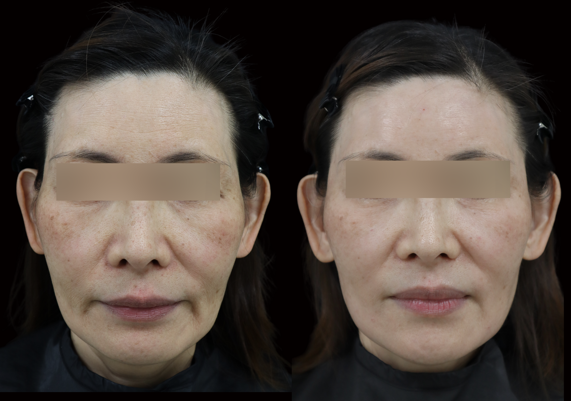 ヒアルロン酸治療の施術前後を正面から比較した61歳女性の症例写真。左が施術前、右が施術後。目元は匿名化処理済み
