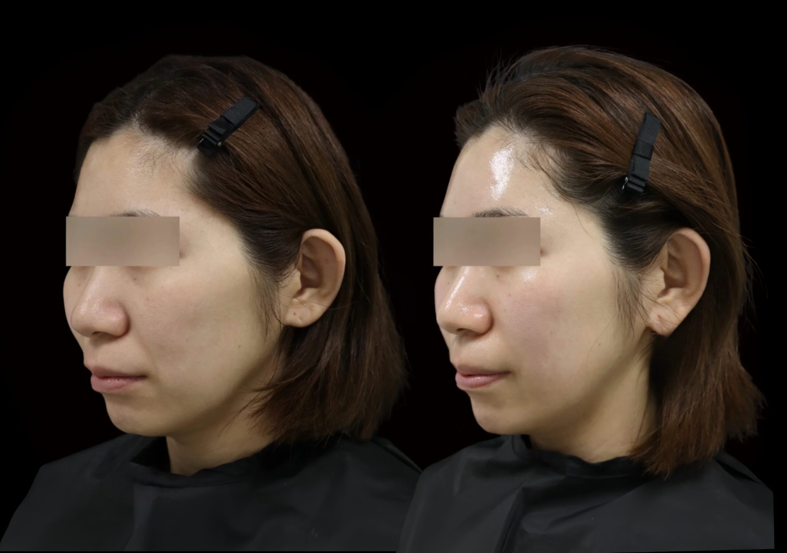 ヒアルロン酸注入治療の施術前と施術後を斜めから比較した35歳女性の症例写真。左が施術前、右がジュビダームビスタ ボリューマXC 4.0cc注入および額・眉間のボトックス注射後。画像内では目元を匿名化