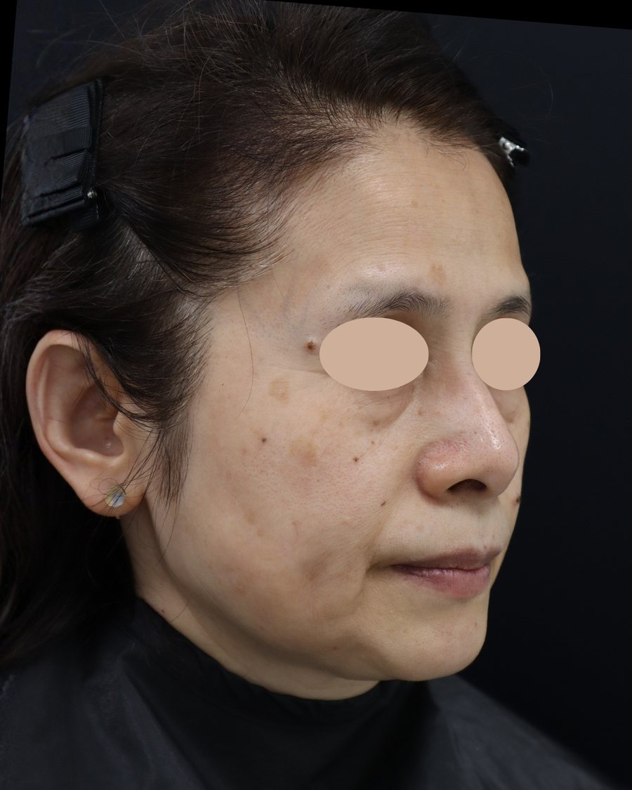 ヒアルロン酸注入治療の施術前の症例写真。60代女性を斜めから撮影。目元は匿名化処理済み