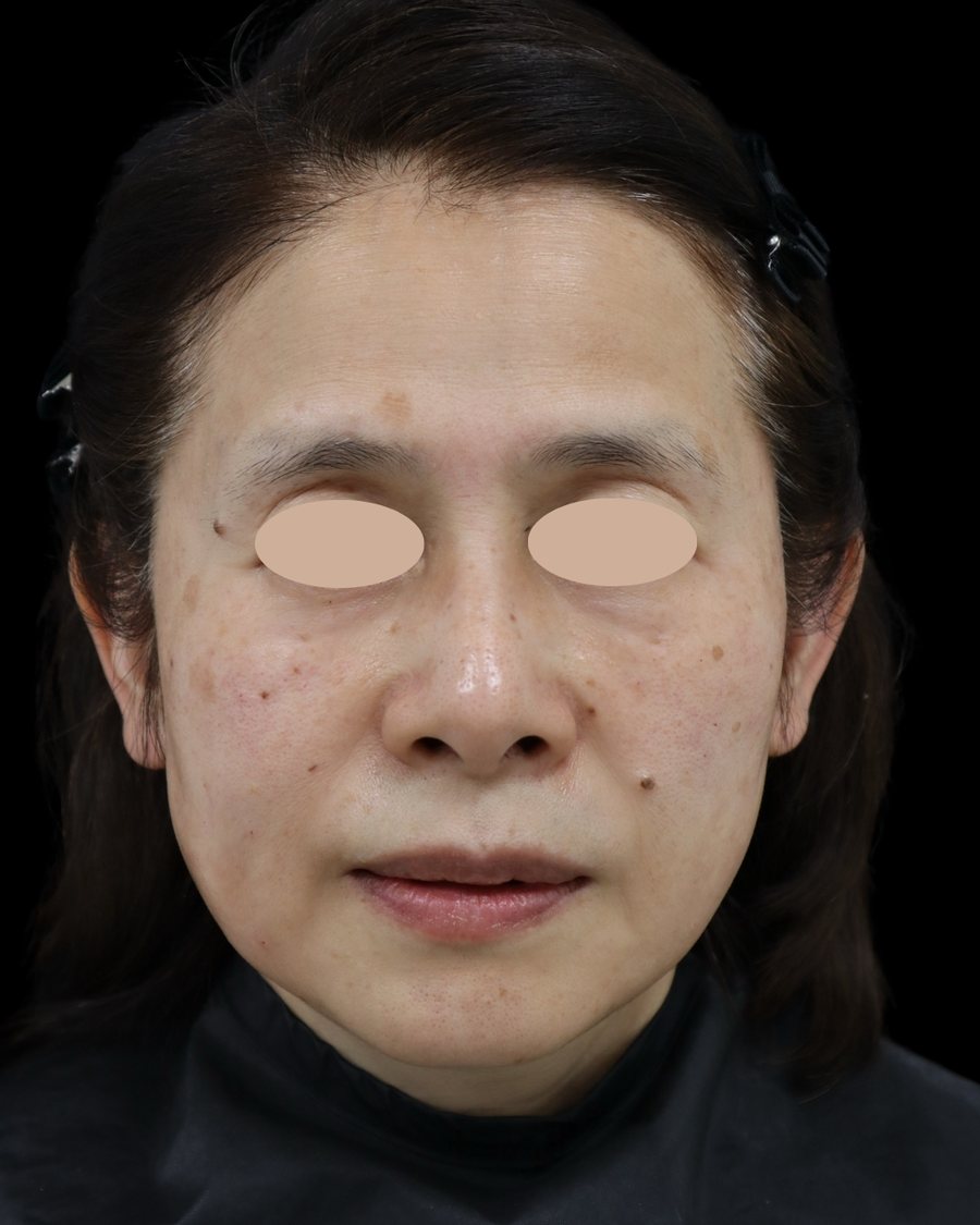 ヒアルロン酸注入治療の施術後の症例写真。60代女性を正面から撮影。目元は匿名化処理済み