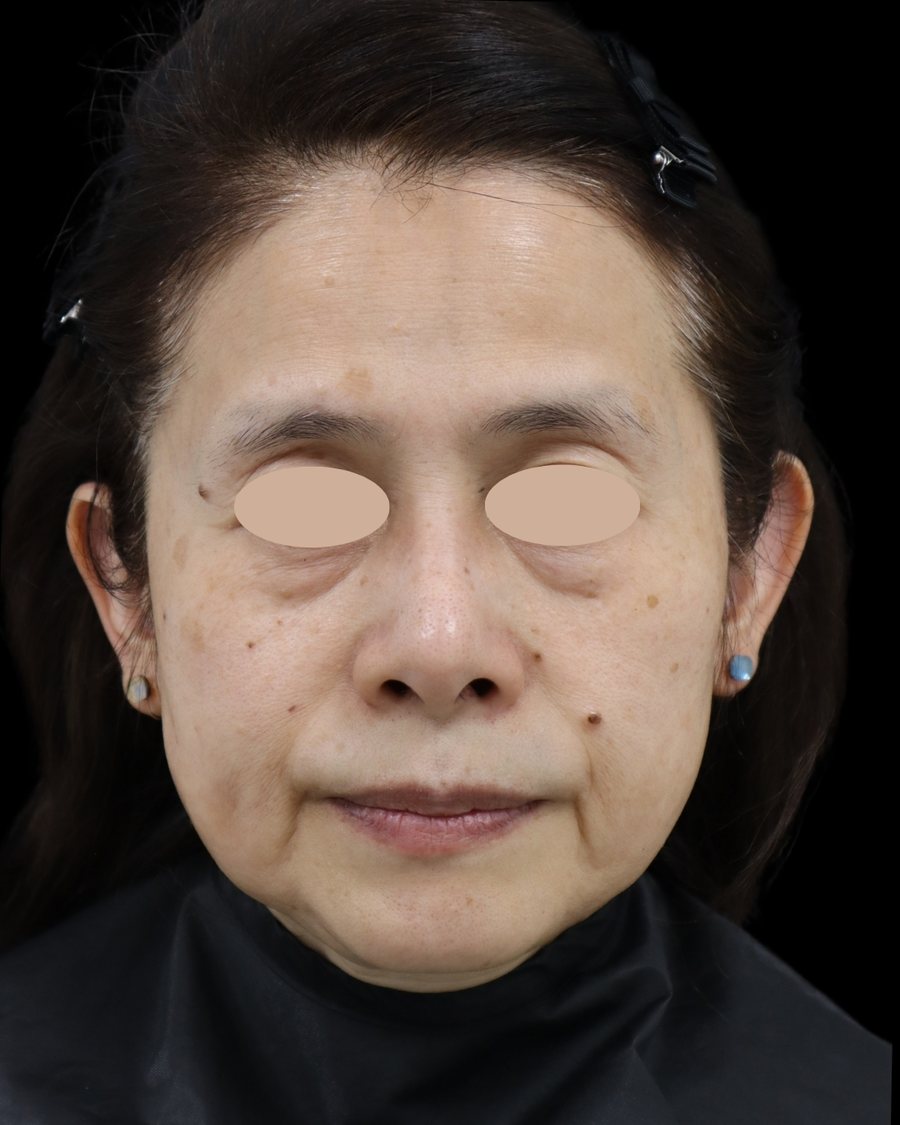 ヒアルロン酸注入治療の施術前の症例写真。60代女性を正面から撮影。目元は匿名化処理済み