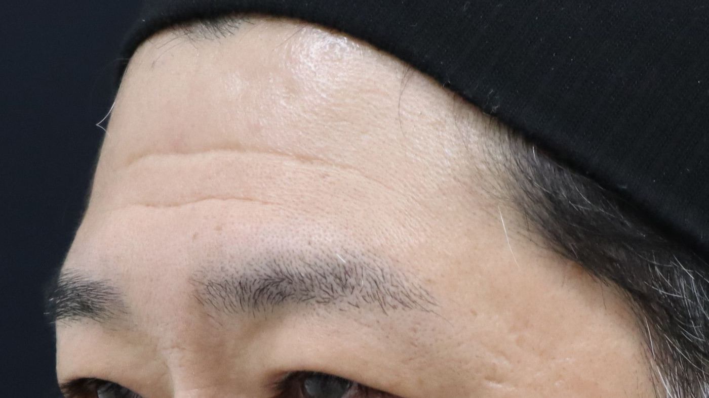 症例11 おでこのしわ 治療前